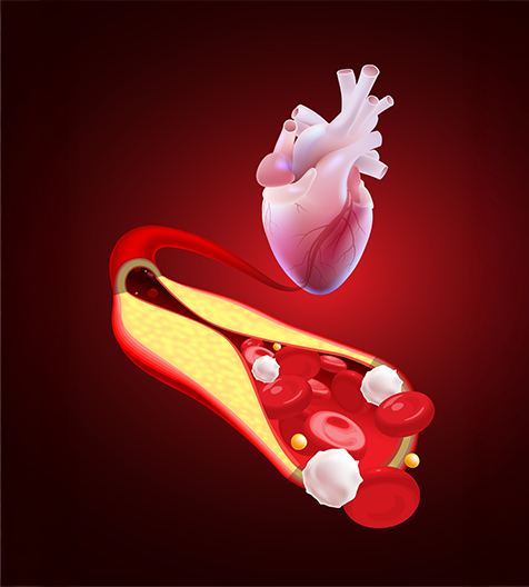 high-cholesterol-1 high-cholesterol-1
